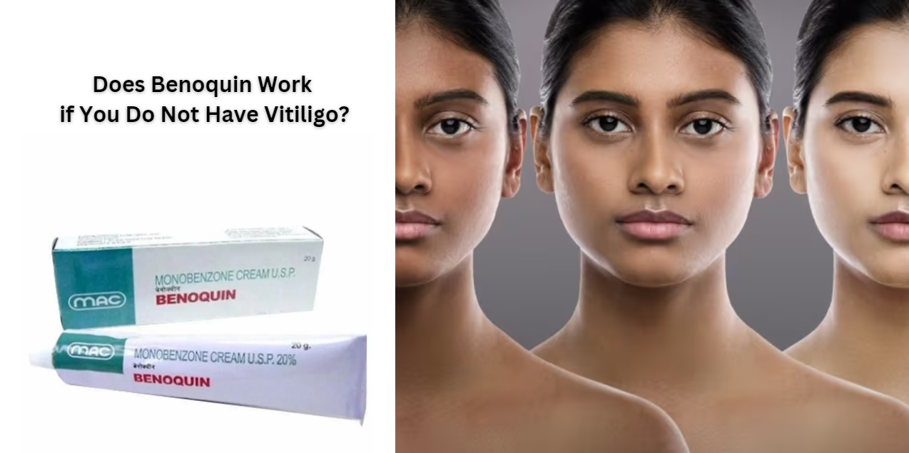 Does Benoquin cream Monobenzone Work if you do not have Vitiligo
